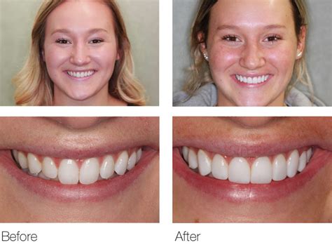 composite veneers near me|Composite Veneers Pros & Cons, Procedure, Cost, and Alternatives.
